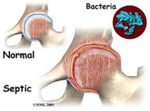 Image result for prosthetic joint infections