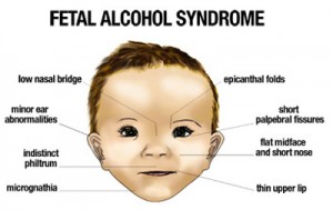 New Guideline: Diagnosis of Fetal Alcohol Spectrum Disorder | Nurses ...