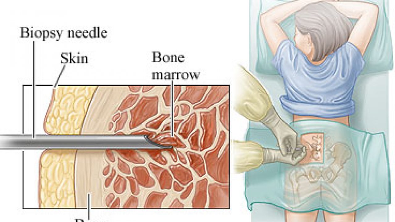 posterior iliac crest bone marrow biopsy