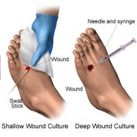 Wound Culture - Goal, Test Overview, procedure for Aerobic & Anaerobic